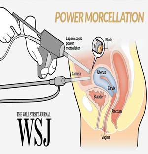 Power Morcellators – Hysterectomy Surgery