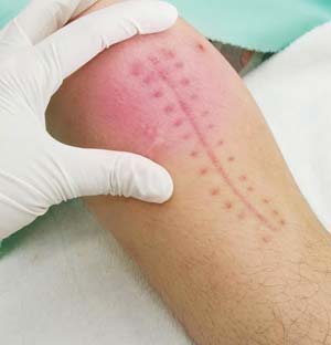 Zimmer Persona® Knee Replacement Recall